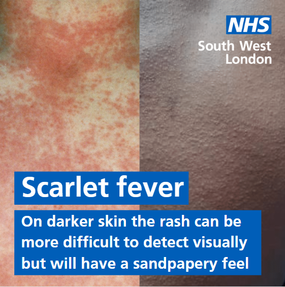 PT – Coping with scarlet fever