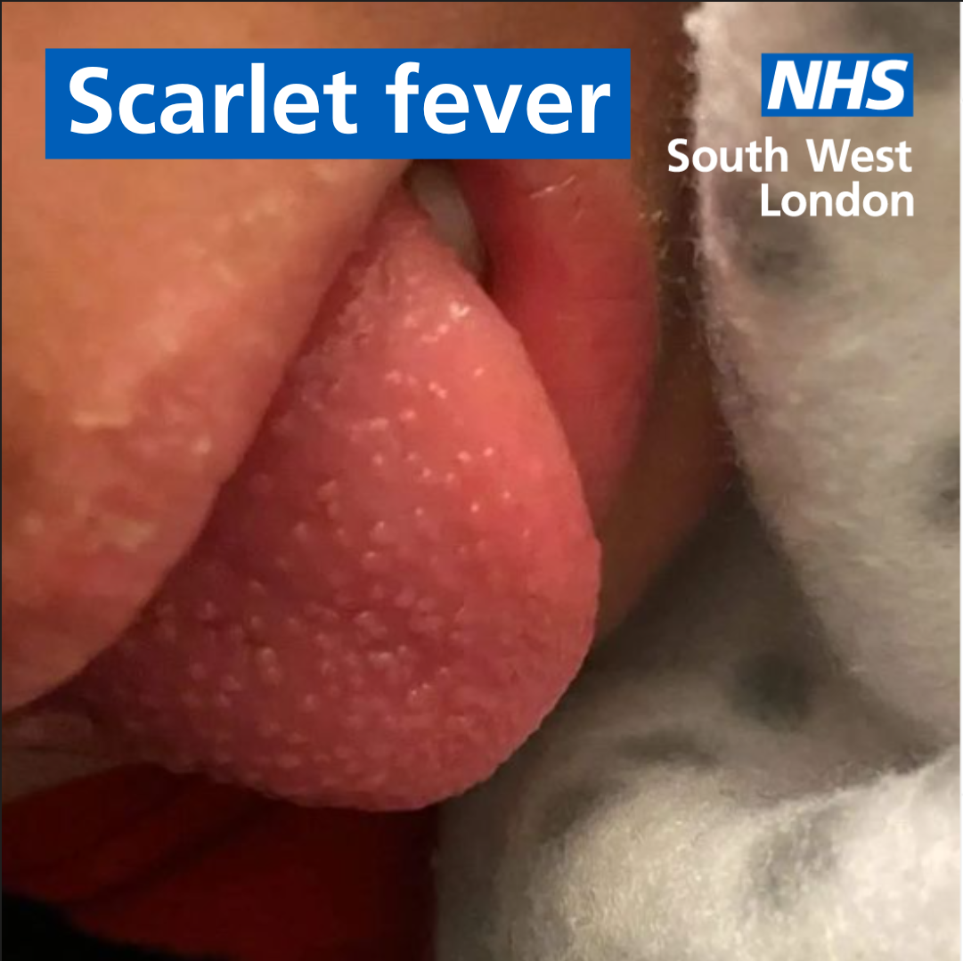 How to spot the symptoms of scarlet fever in your child