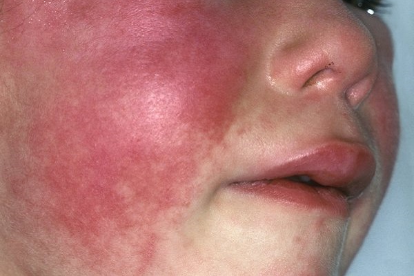 Scarlet fever - what you need to know - Wandsworth Borough Council